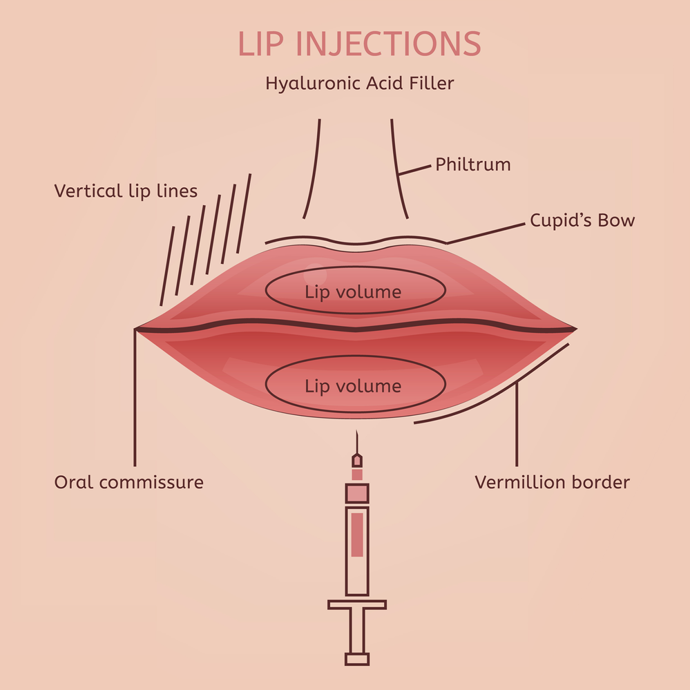 A diagram of lip injections with hyaluronic acid filler