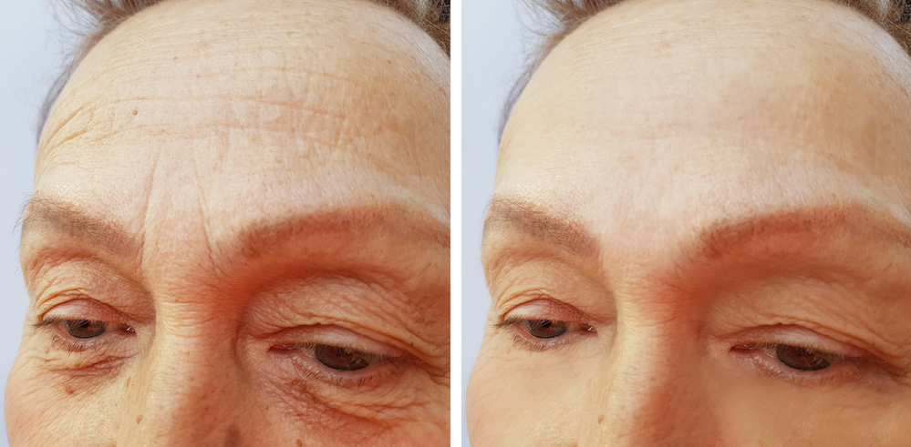 A before and after photo of a woman 's forehead.