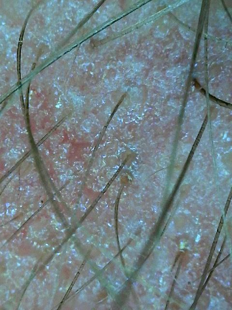 Primer plano de piel seca y escamosa con vello visible y pequeñas escamas blancas.