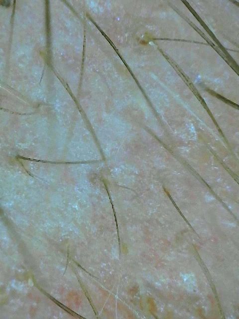 Primer plano de piel humana con vello fino visible y textura seca y escamosa.