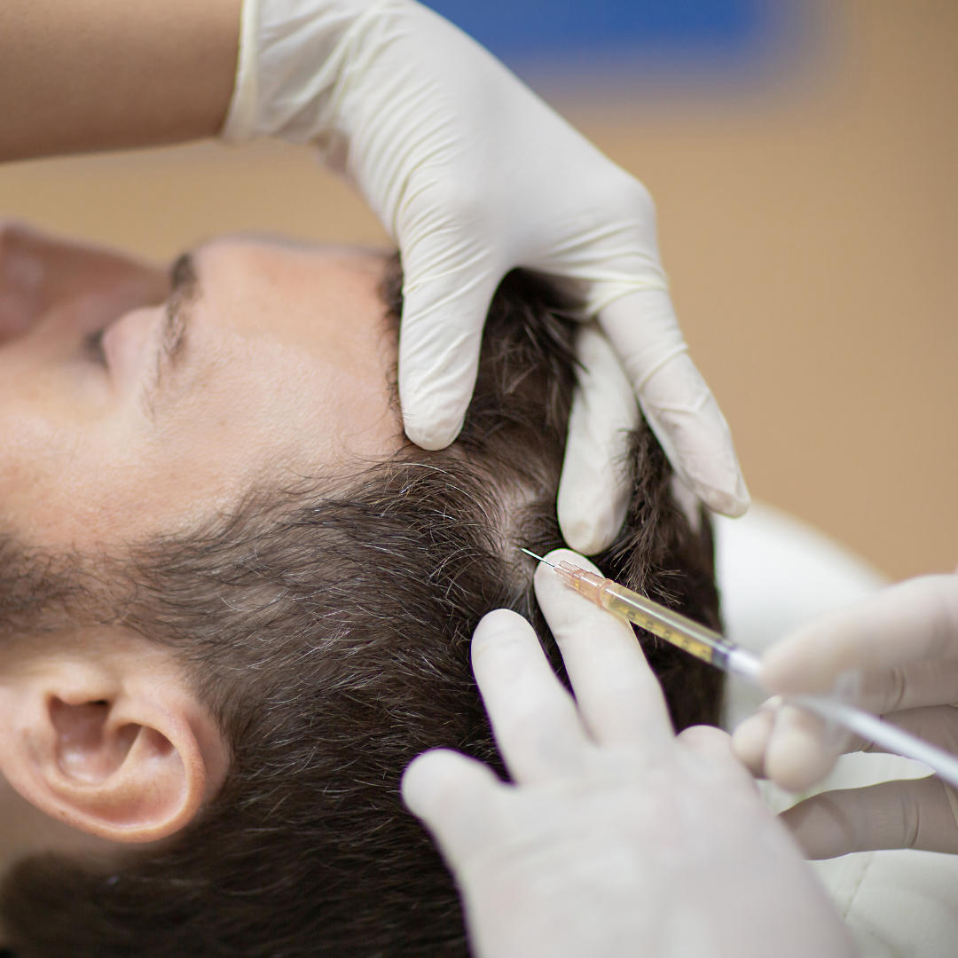 Procedimiento de mesoterapia capilar para tratar la alopecia androgenética.
