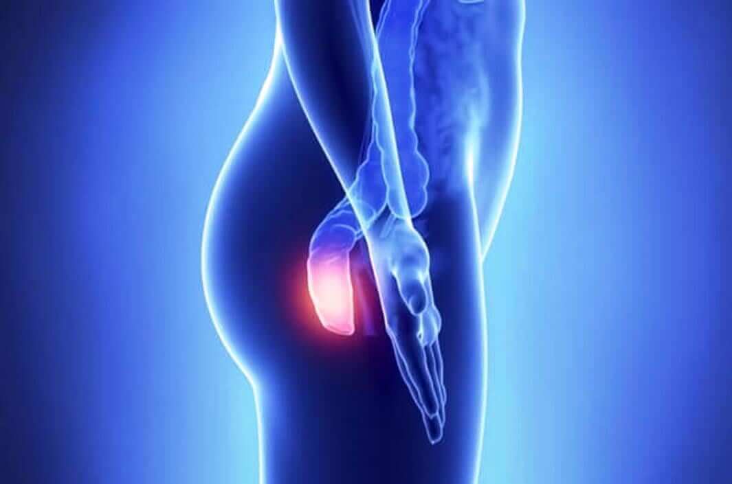 DR. MARCO VINICIO PEREZ MARISCAL - cáncer de recto