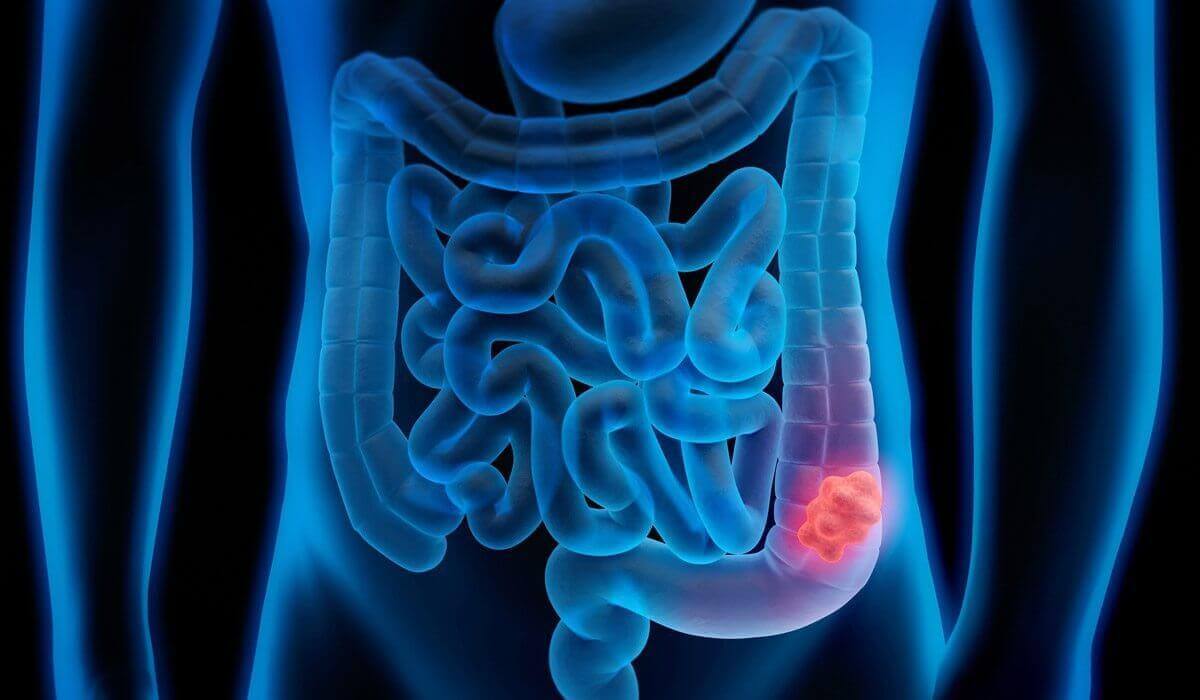 DR. MARCO VINICIO PEREZ MARISCAL - cáncer de colon