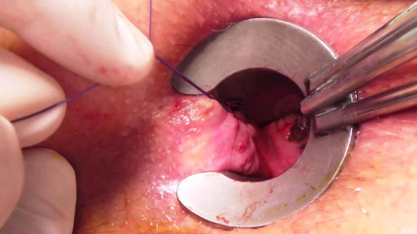 DR. MARCO VINICIO PEREZ MARISCAL - cirugía de ano