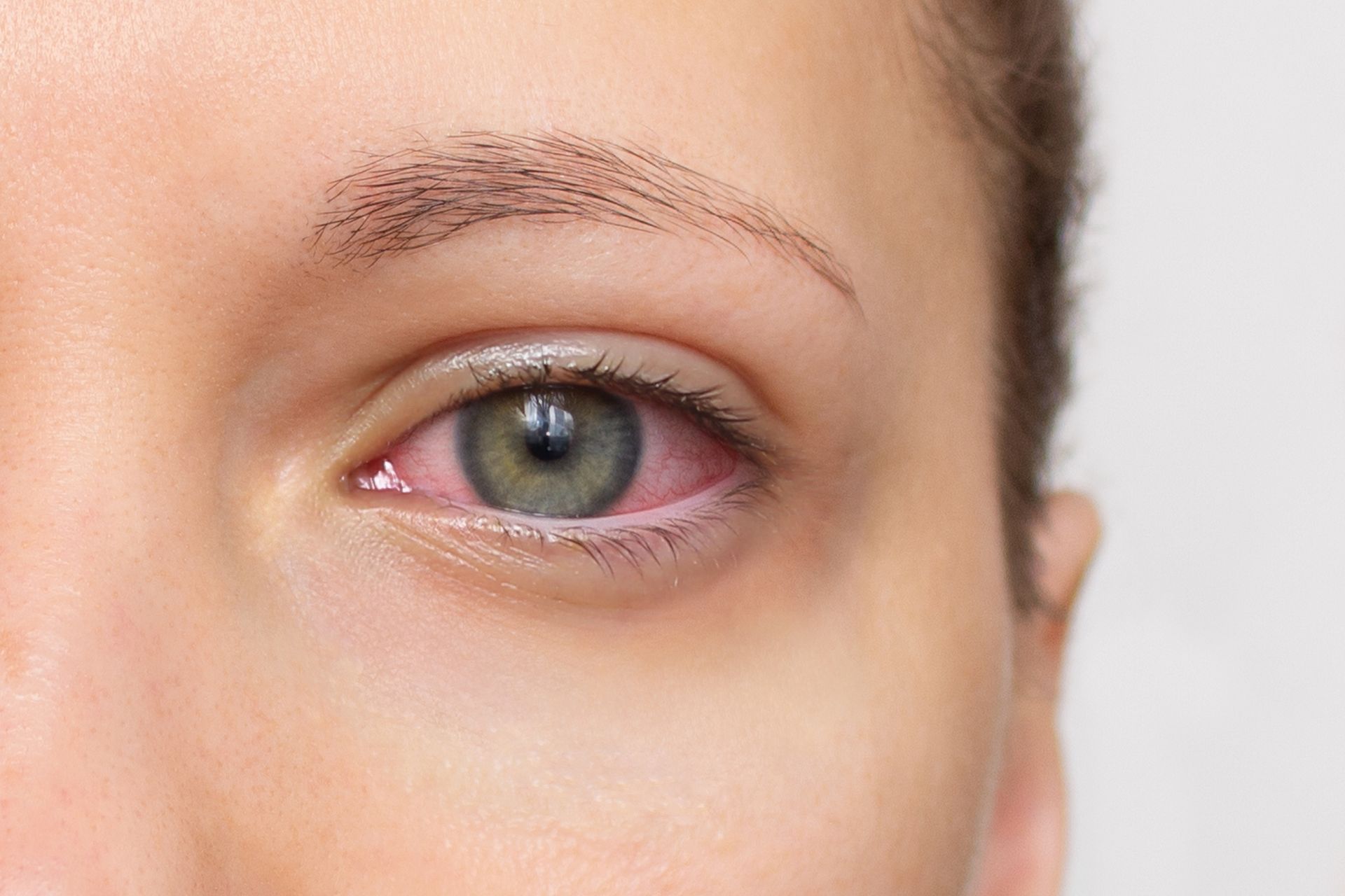 A close up of a woman 's red eye.