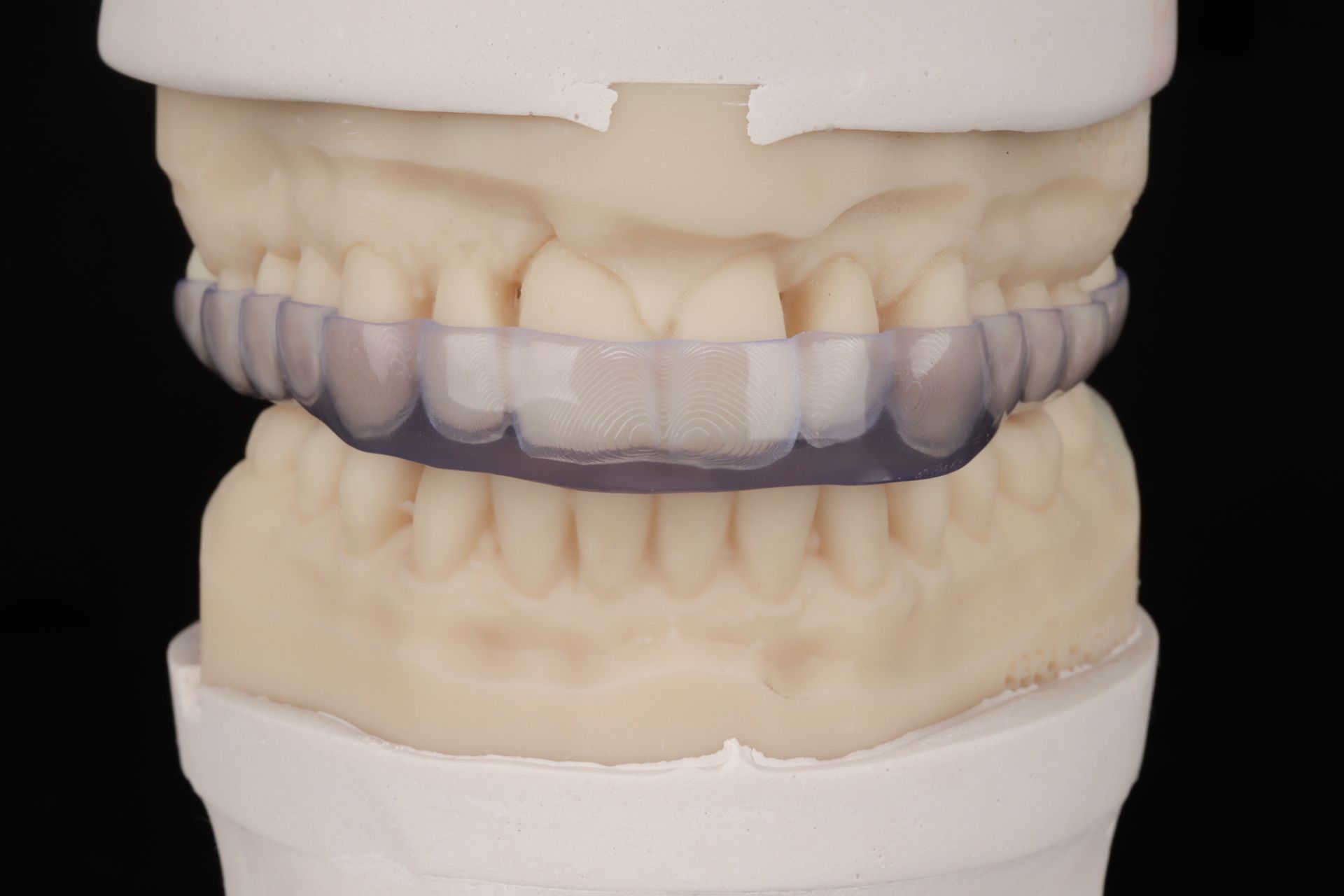 Dental model with upper and lower teeth, showing a translucent purple aligner in between