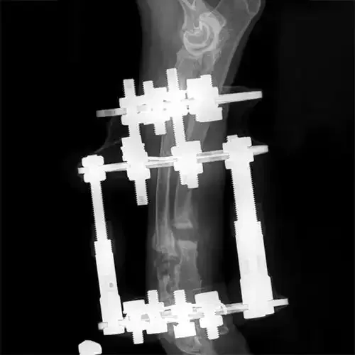X-ray of a wrist with a metal external fixation device and pins stabilizing the bones