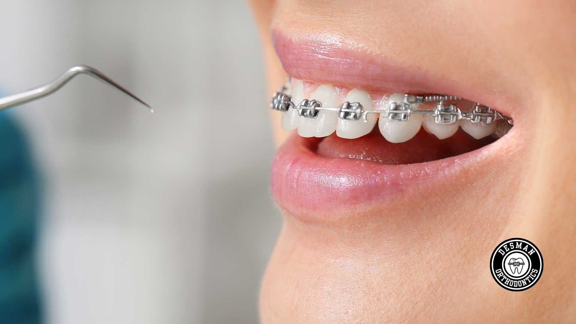 Close-up of a smiling mouth with metal braces and a dental tool near the teeth