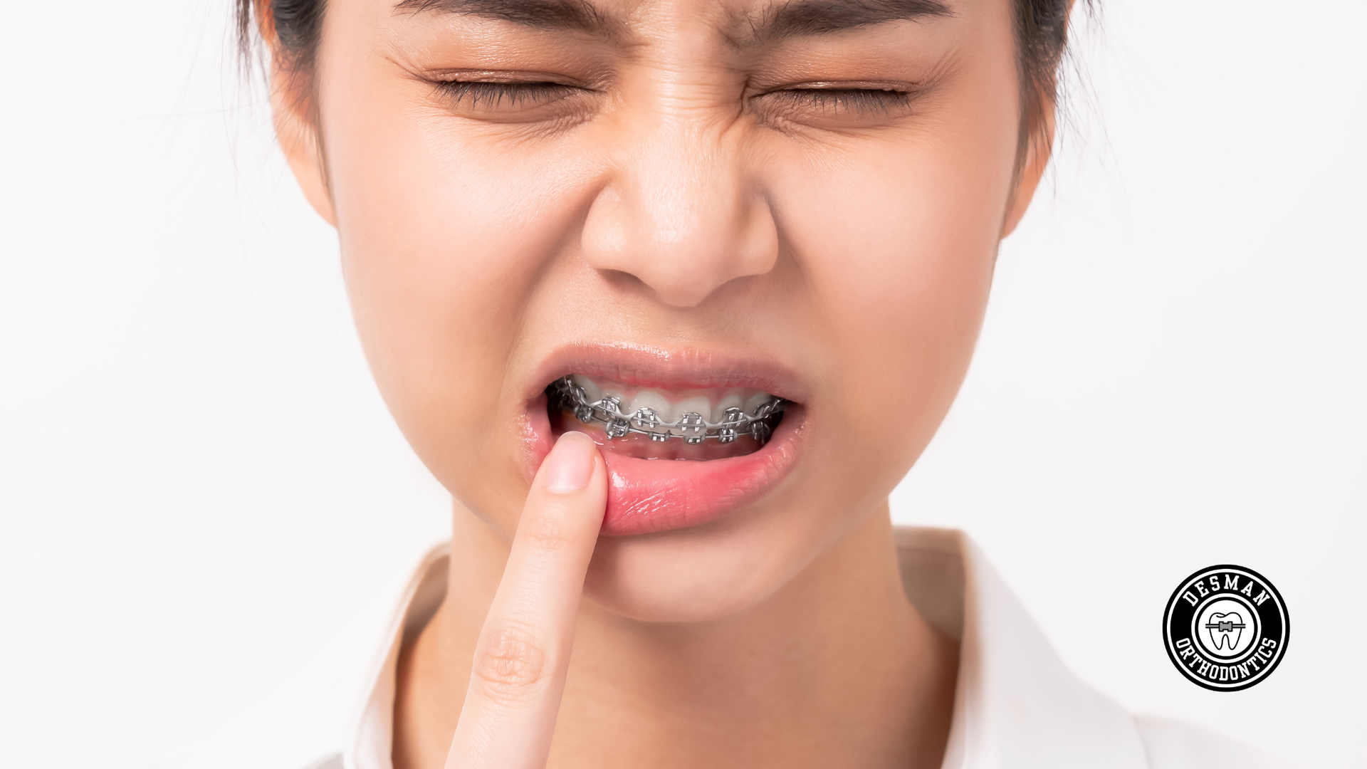 Close-up of a person with braces pressing a finger to their lower lip, wincing in pain