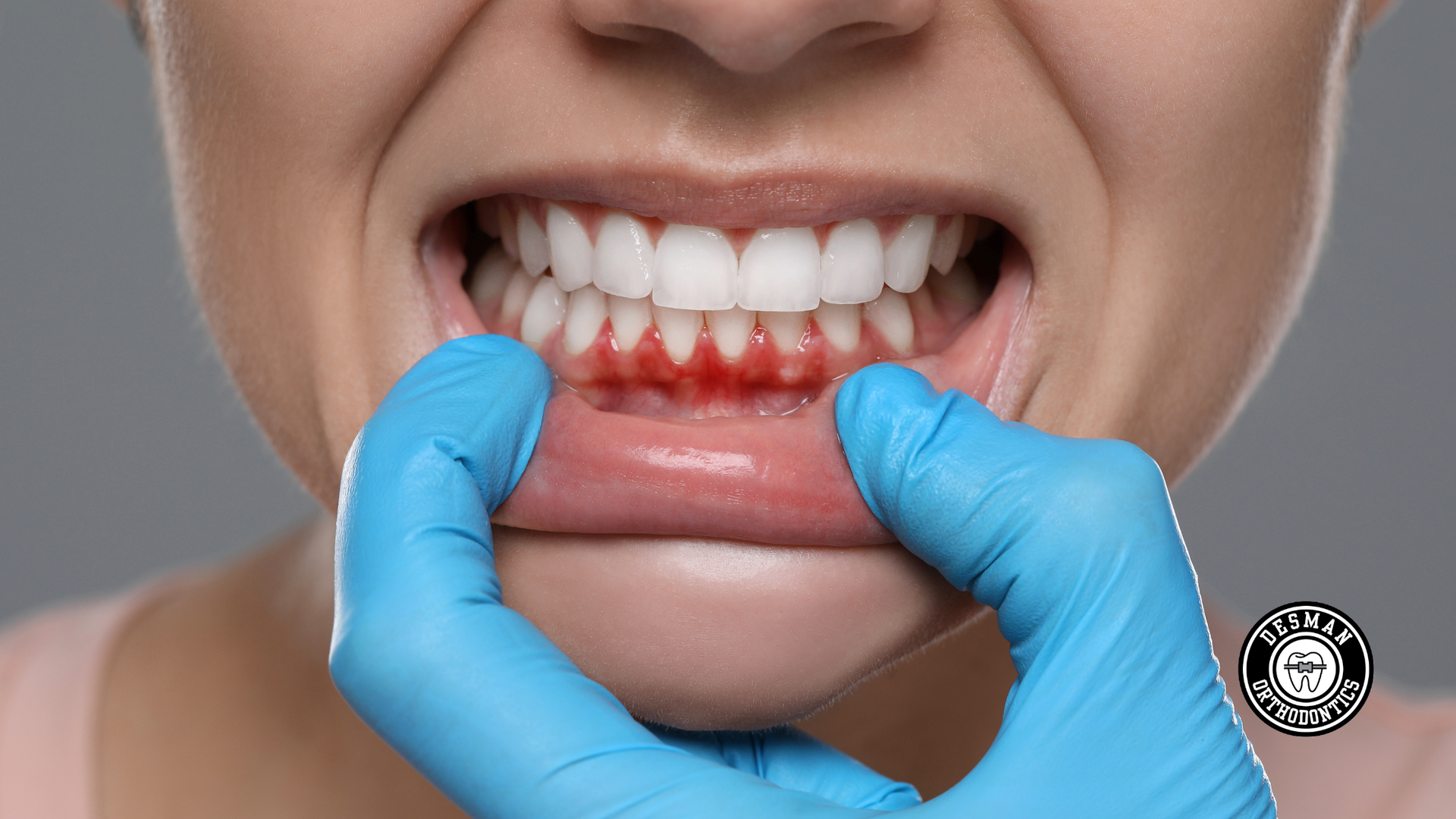 Close-up of gums being examined by gloved hands, showing red, inflamed tissue around the lower teeth.