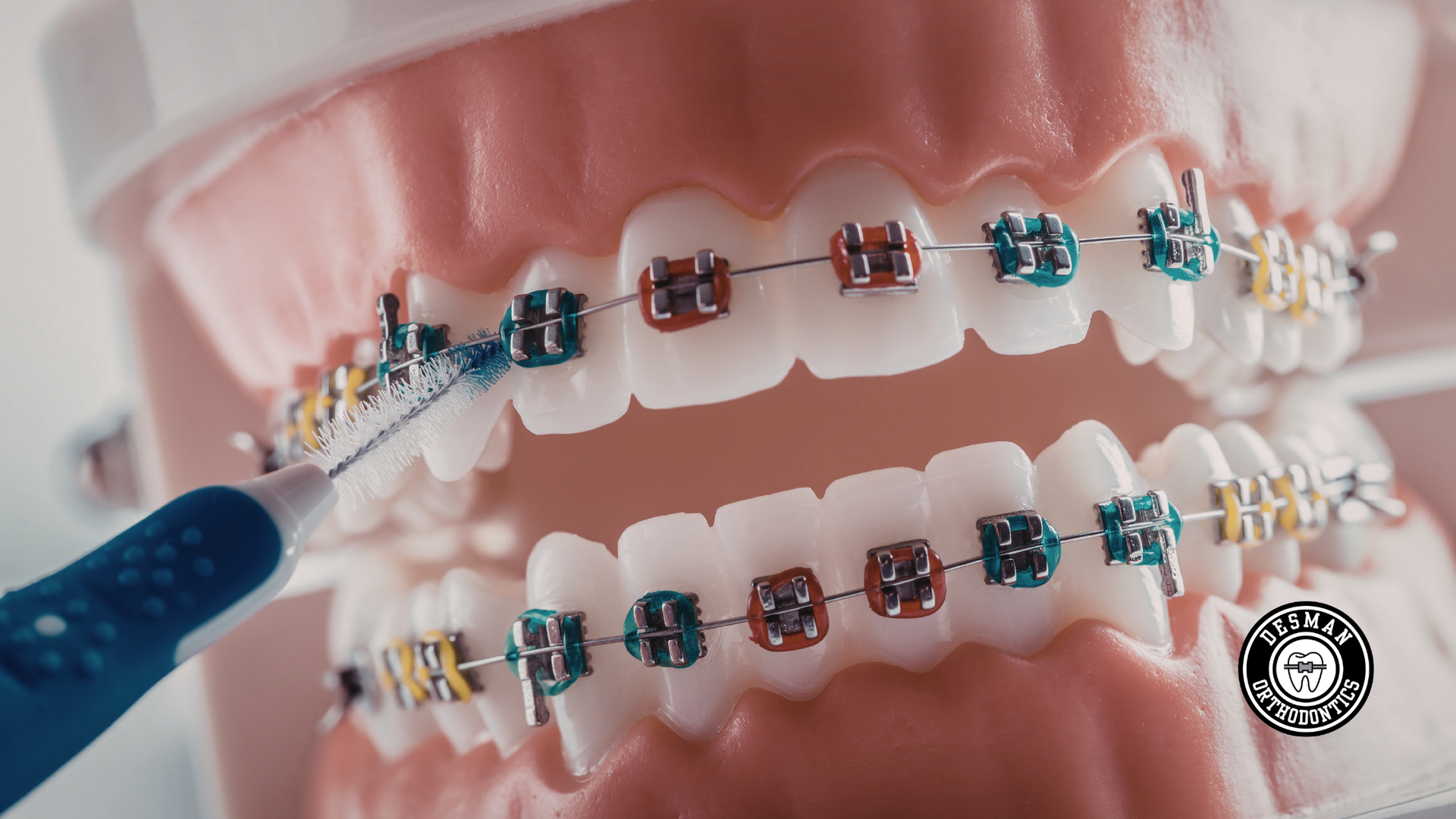 Close-up of braces on teeth being cleaned with a toothbrush