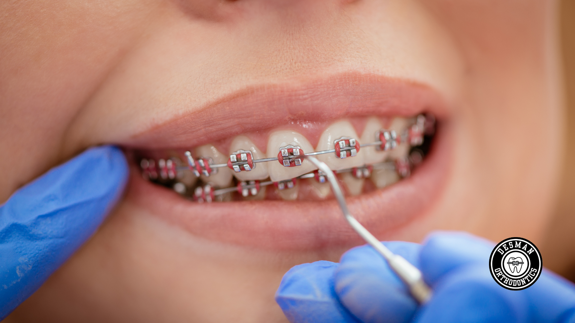 Gloved hands cleaning braces on teeth with a dental tool