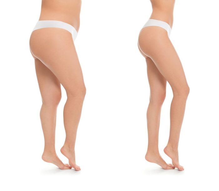 Laserlipolisi per glutei