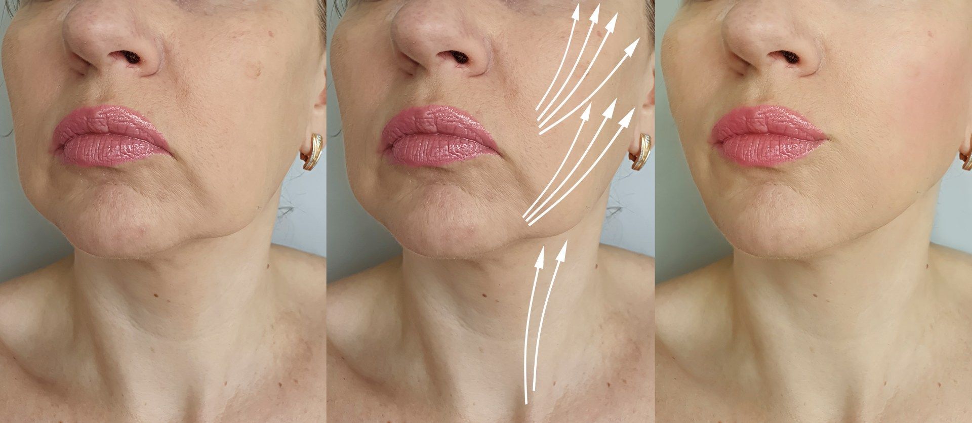 Filler e botox