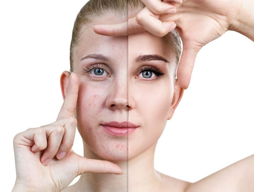 Trattamento peeling viso