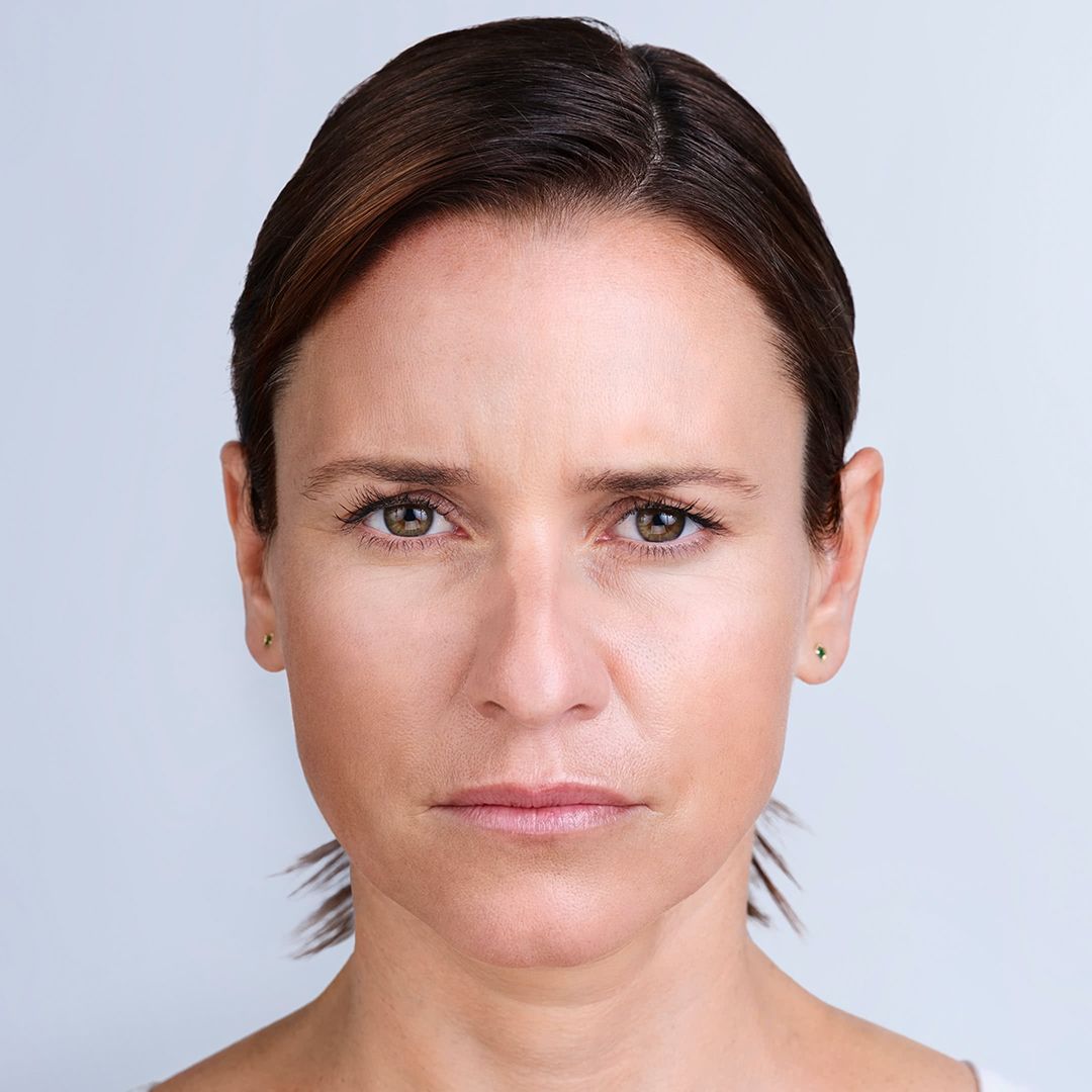 after Xeomin injections