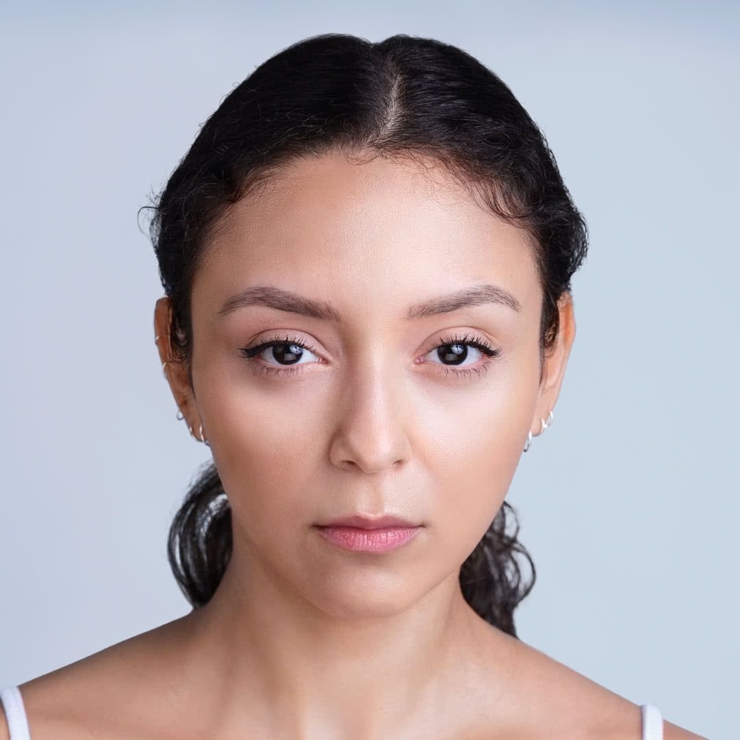 after Xeomin injections