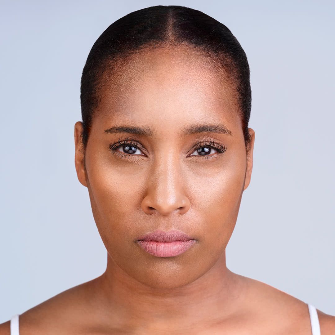 after Xeomin injections