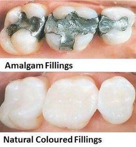 Repairing Your Smile — Epping, VIC — Dento Mak Dental Surgery
