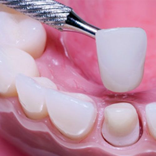 Crowns — Epping, VIC — Dento Mak Dental Surgery