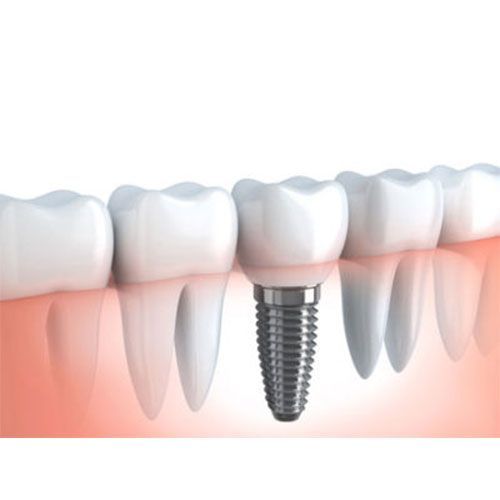 Implants — Epping, VIC — Dento Mak Dental Surgery