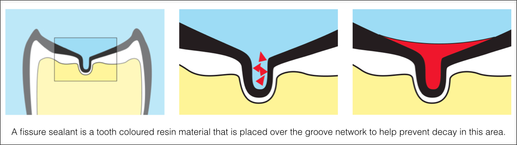 Fissure Sealants — Epping, VIC — Dento Mak Dental Surgery Fissure Sealants — Epping, VIC — Dento Mak Dental Surgery