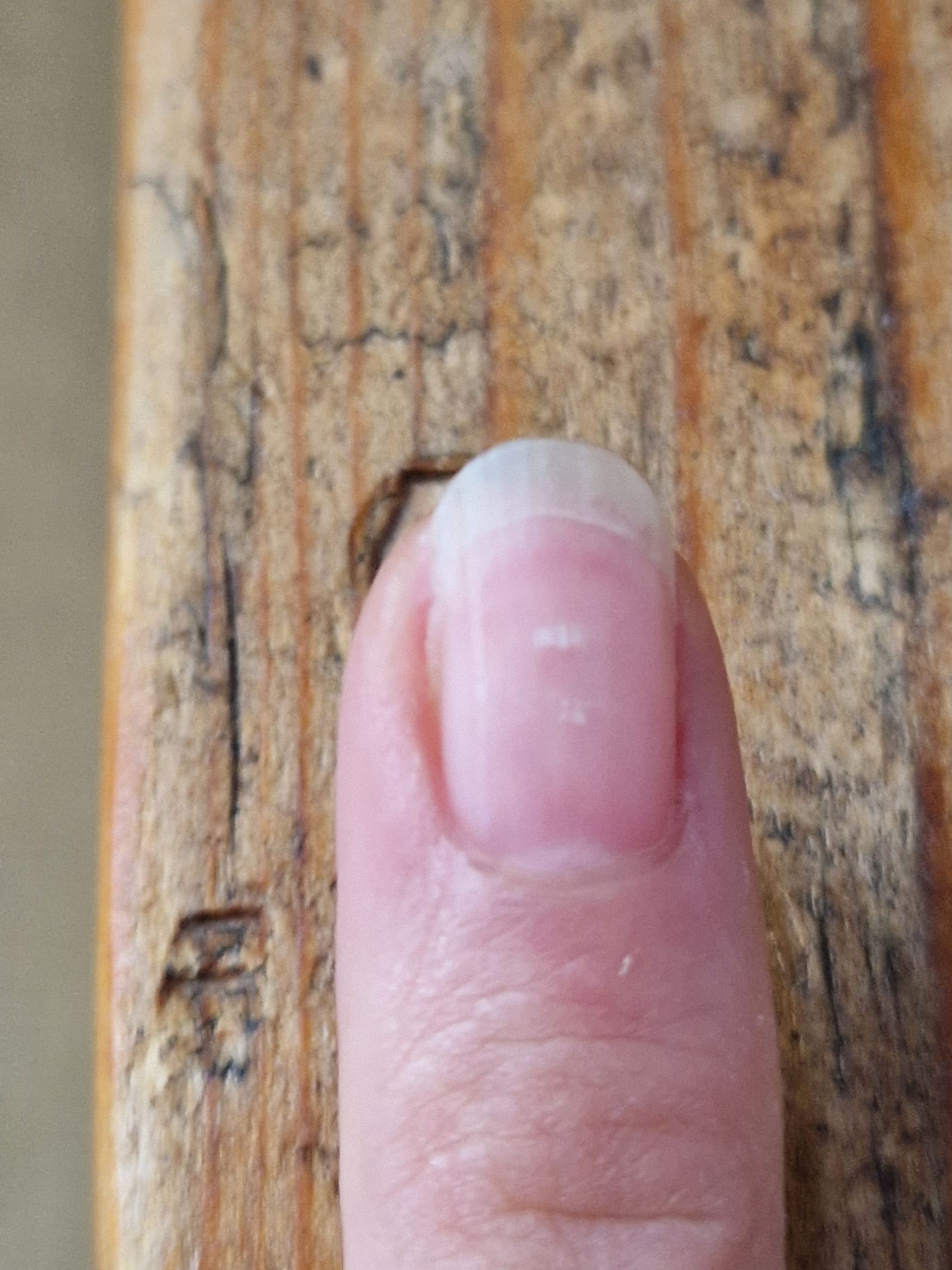 Witte vlekjes op je nagels, veroorzaakt door een zinktekort.