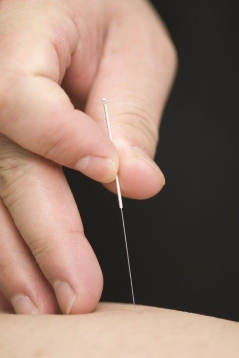 Hand holding a thin acupuncture needle inserted into skin