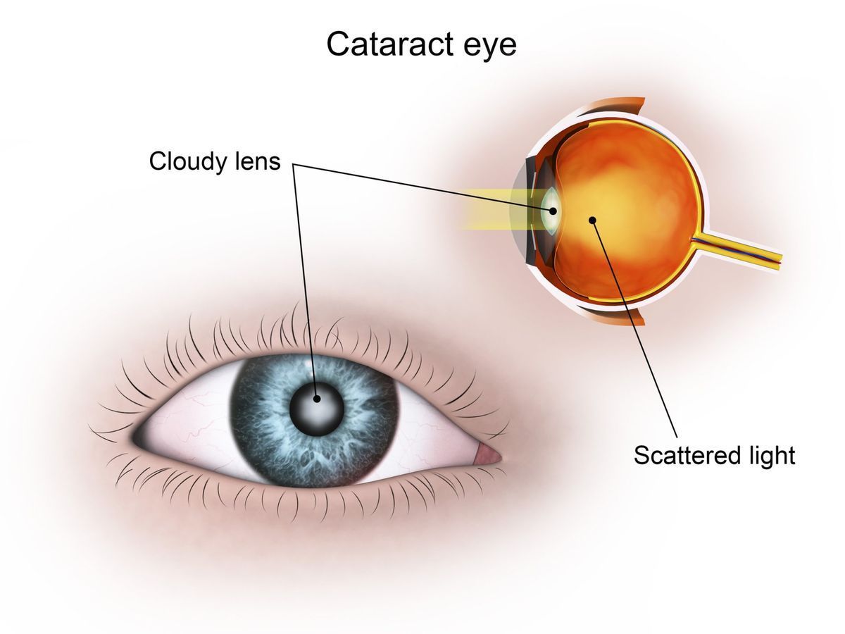 A diagram of a cataract eye with a cloudy lens and scattered light