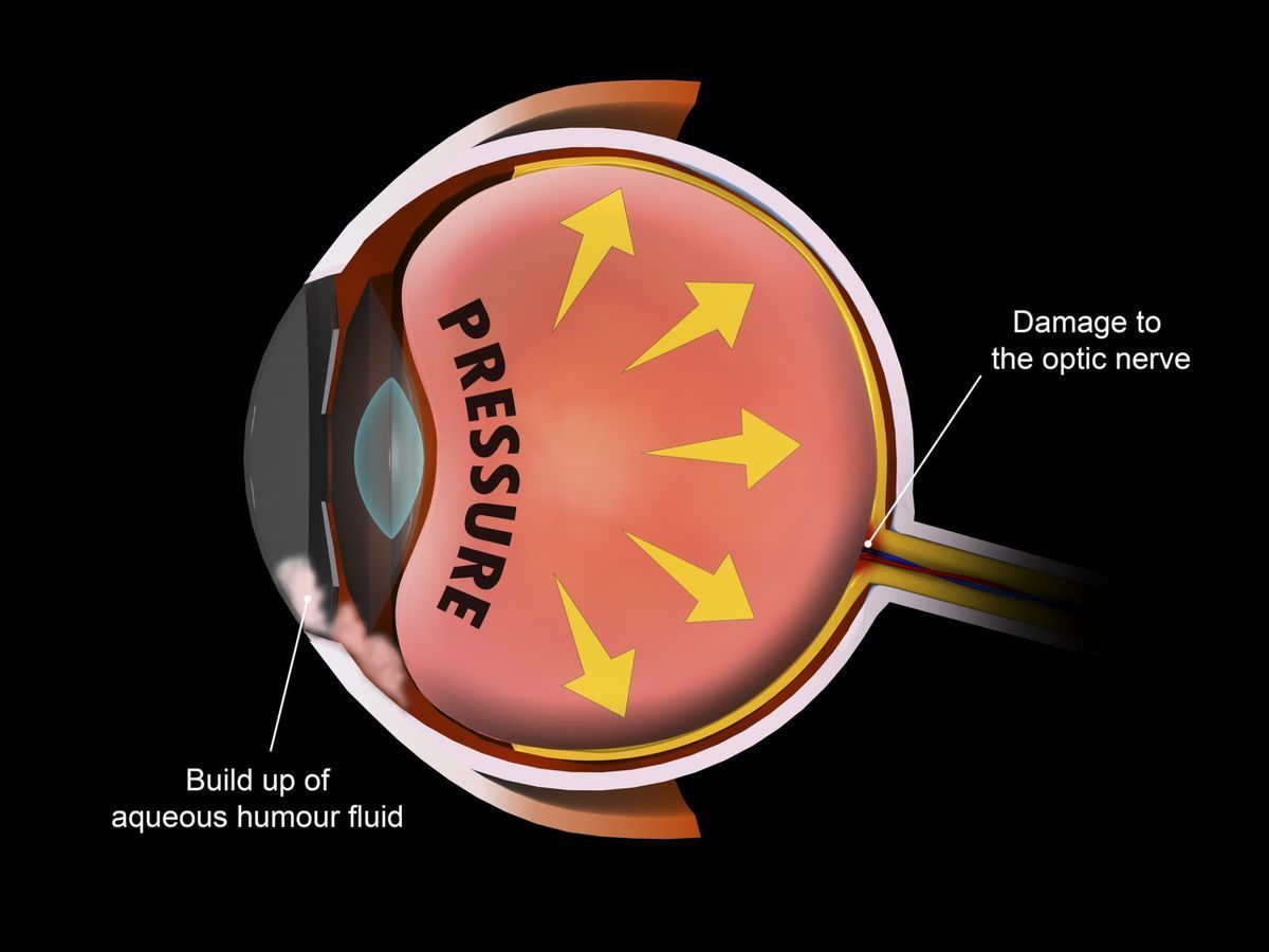 A diagram of a human eye showing pressure and damage to the optic nerve