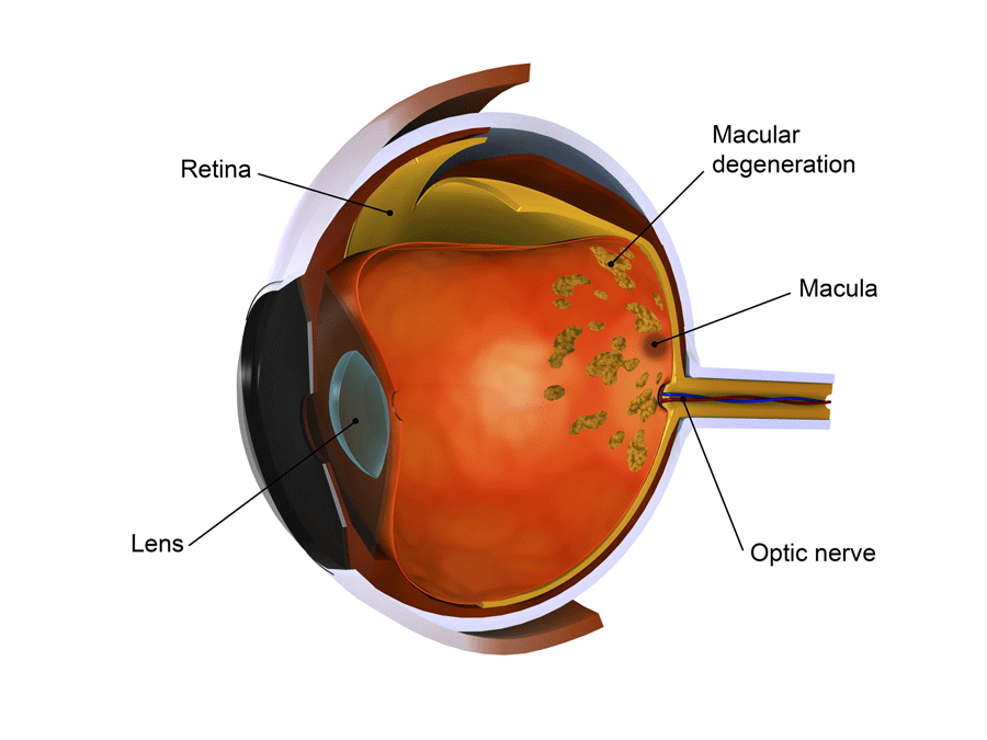 A diagram of a human eye showing the retina , lens , and optic nerve.