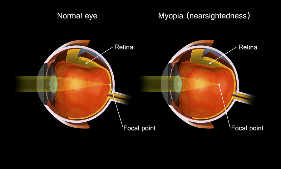 A diagram of a normal eye and a myopia eye