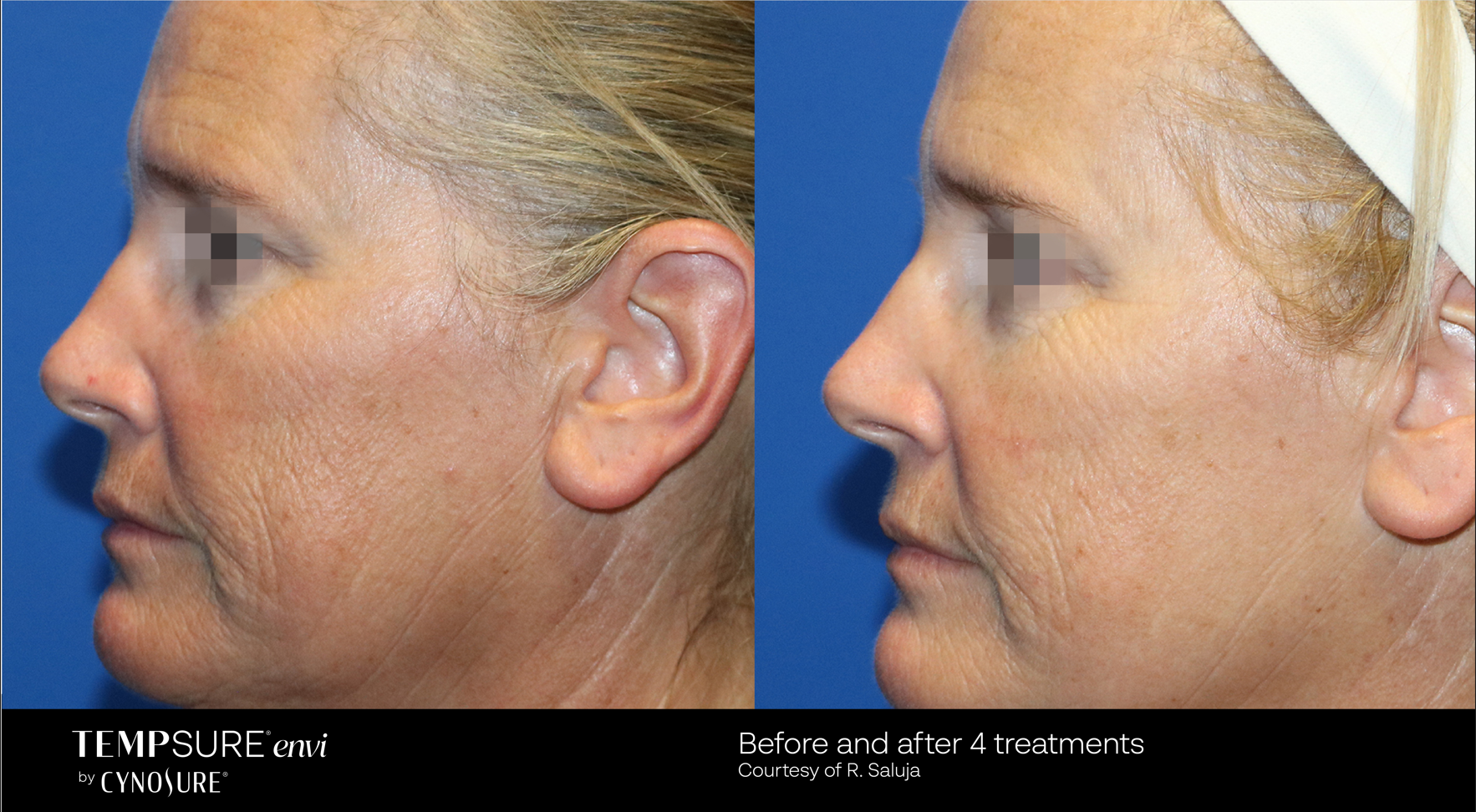 A before and after photo of a woman 's face