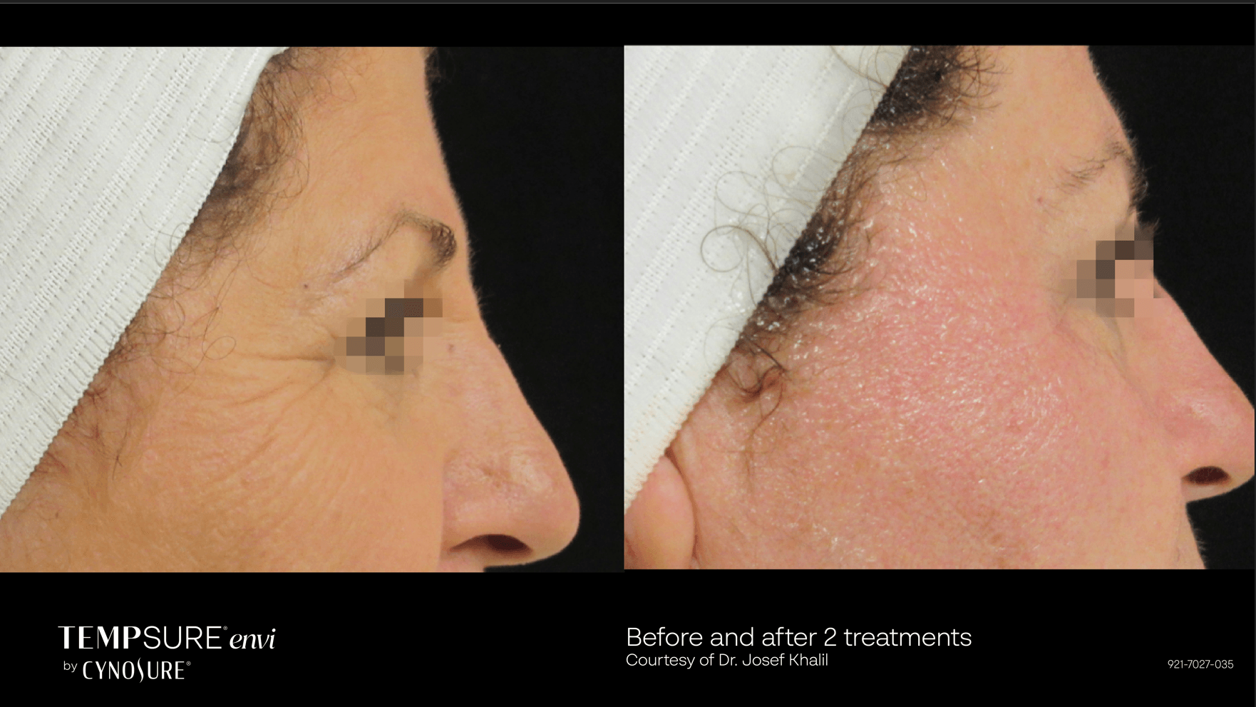 A before and after photo of a woman 's face