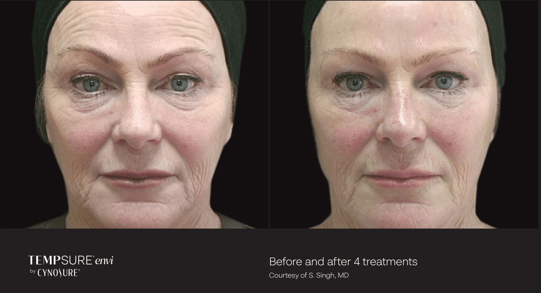 A before and after photo of a woman 's face.
