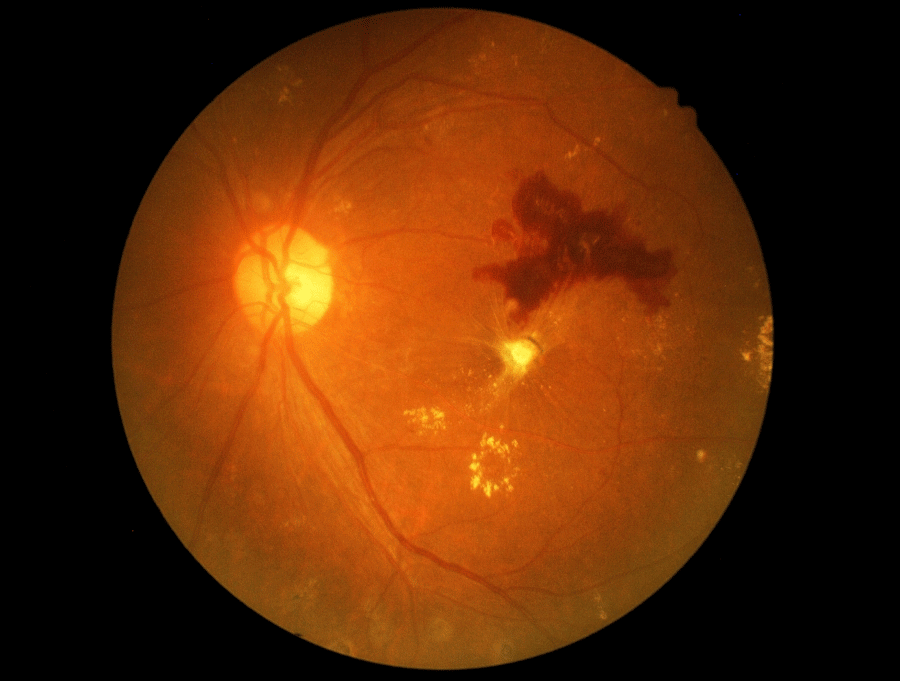 A close up of a person 's eye with a dark spot on it.