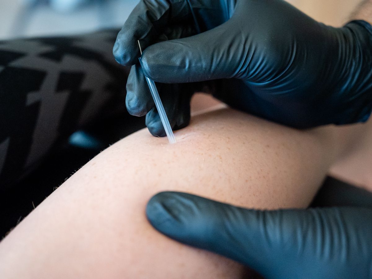 A gloved hand uses a needle with a coiled tip to apply dry needling treatment to a person's leg.
