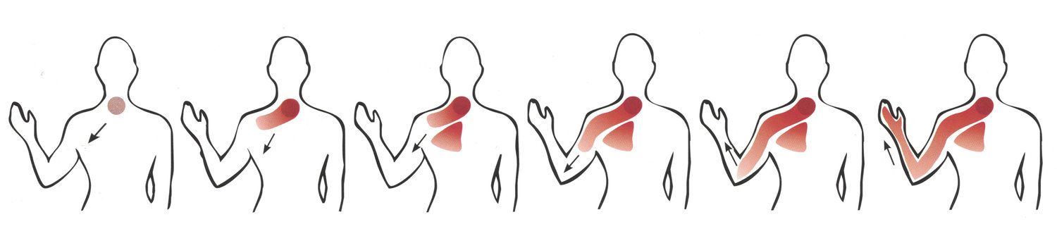 A series of six diagrams showing a red shaded area spreading from the base of the neck down the arm to the hand.