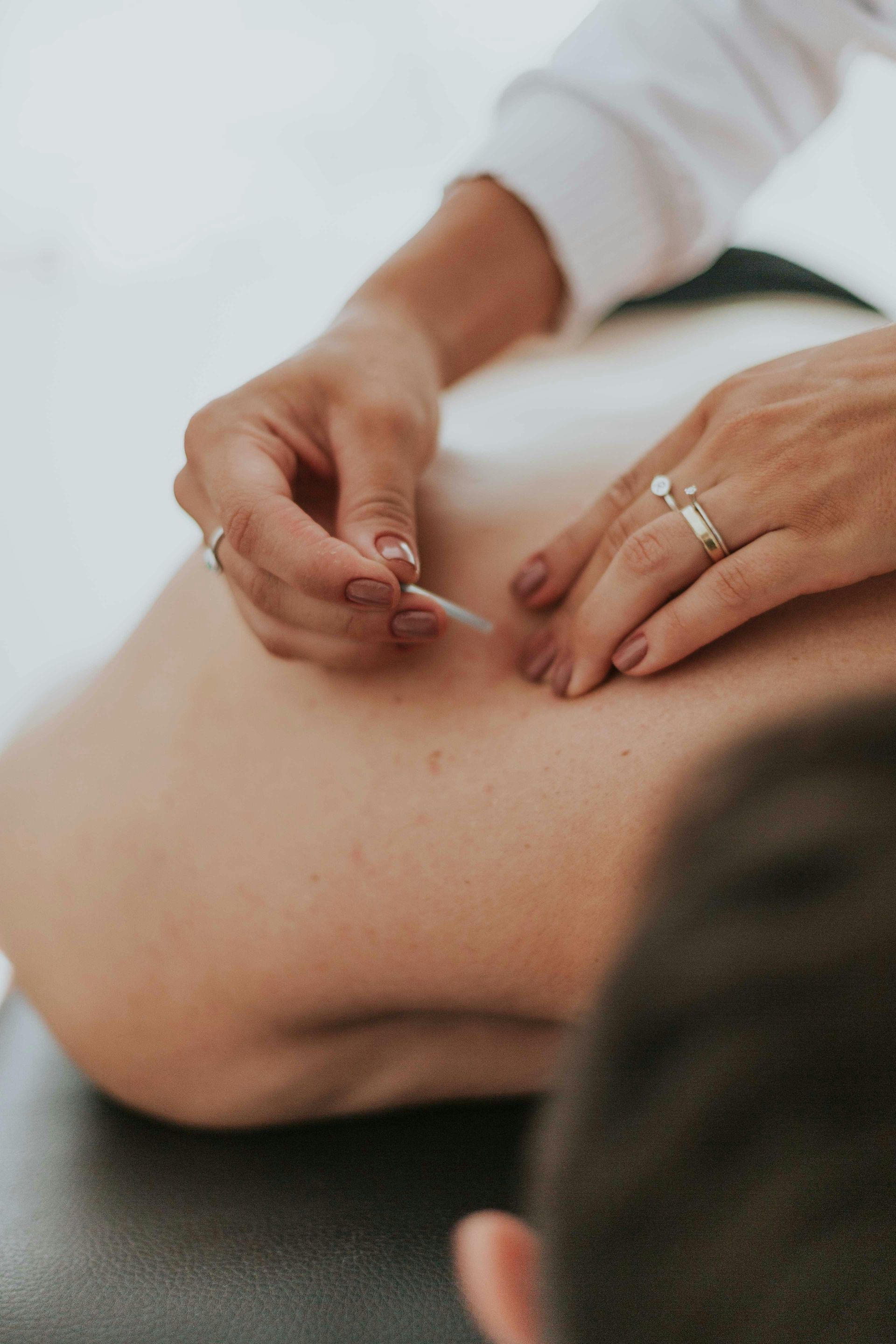 Hands perform acupuncture on a person's upper back, inserting a thin needle into the skin.