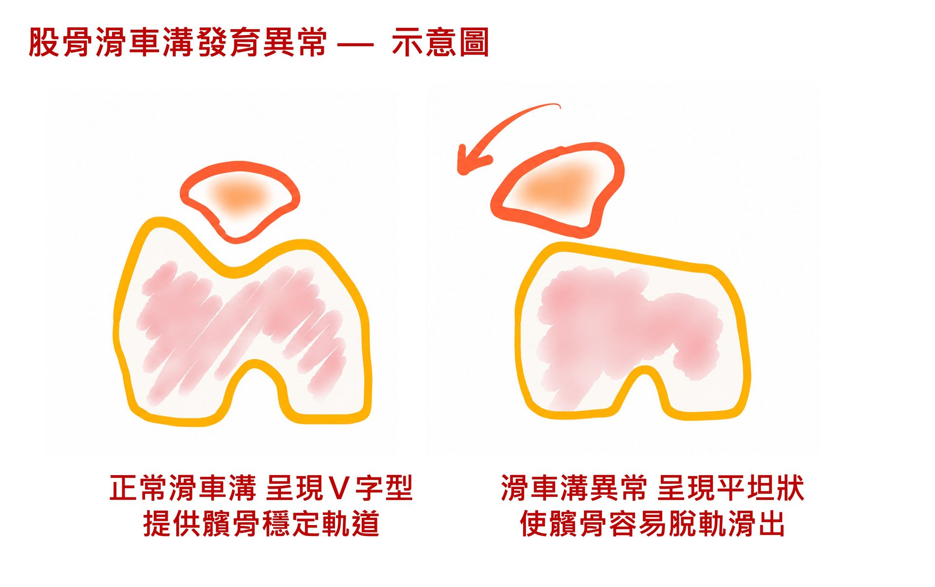 股骨滑車溝發育異常