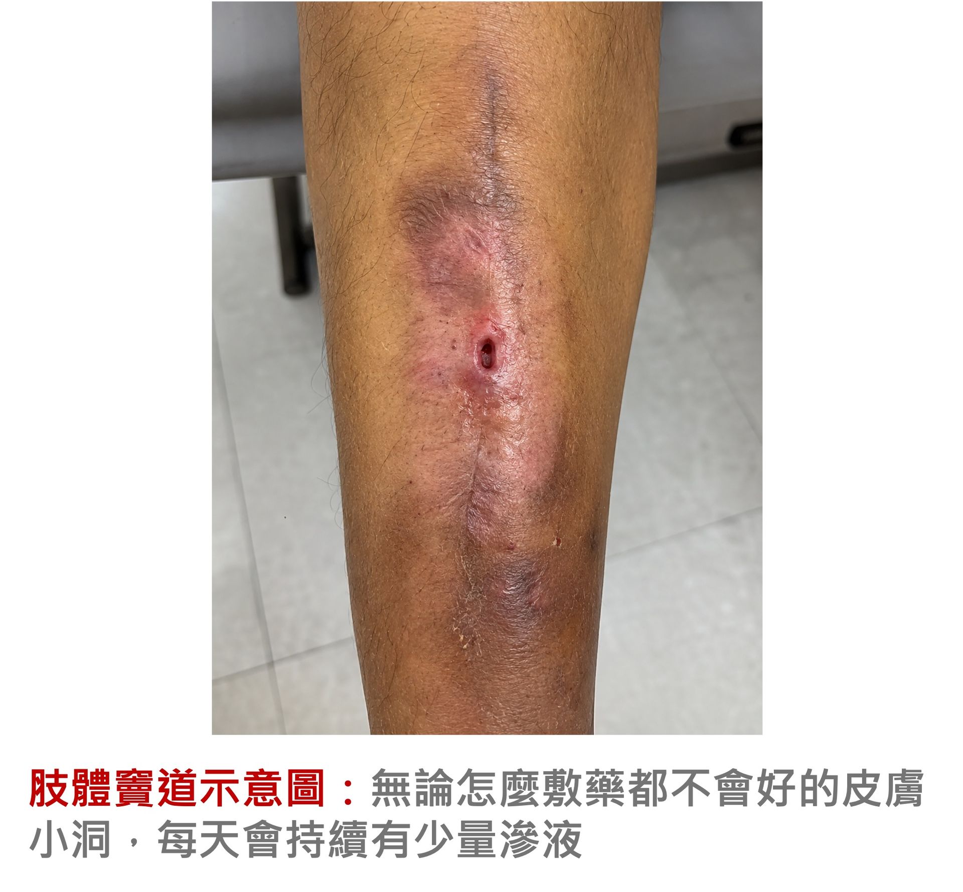 傷口出現瘻管或竇道