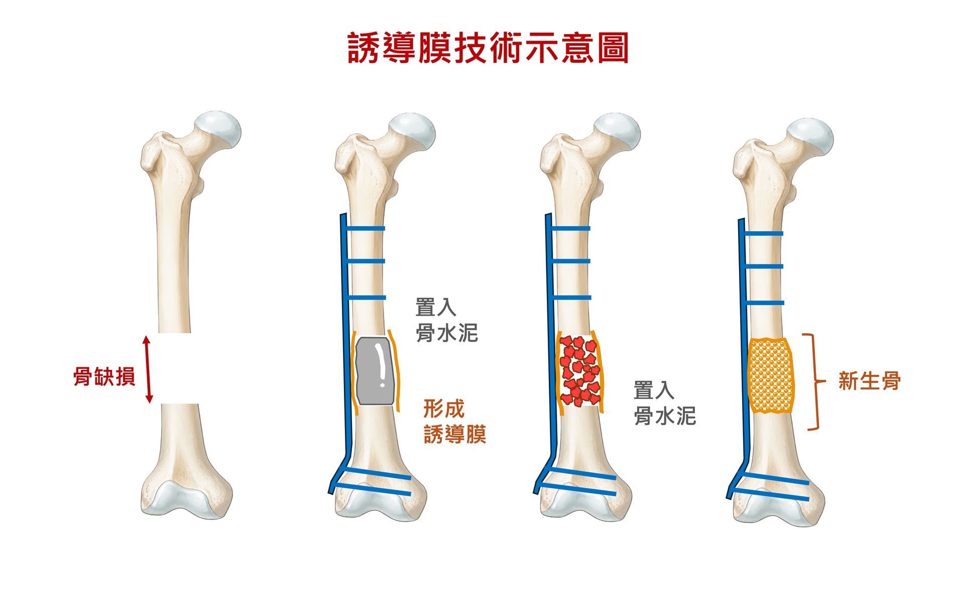 誘導膜骨重建技術