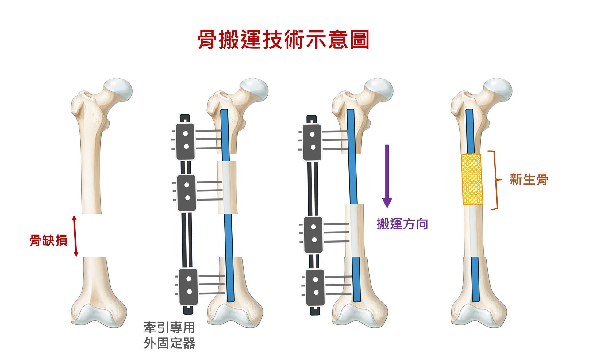 骨搬運技術