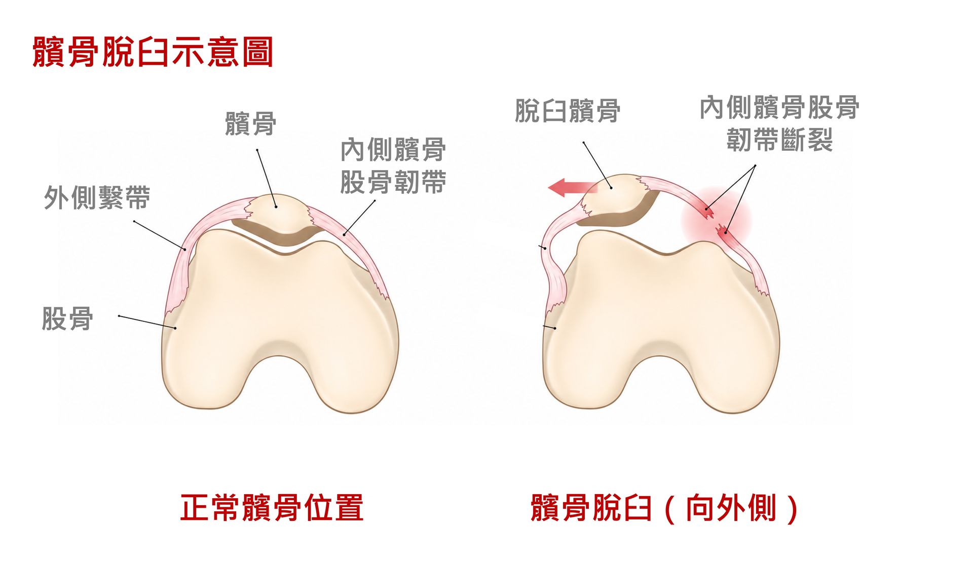 髕骨脫臼示意圖