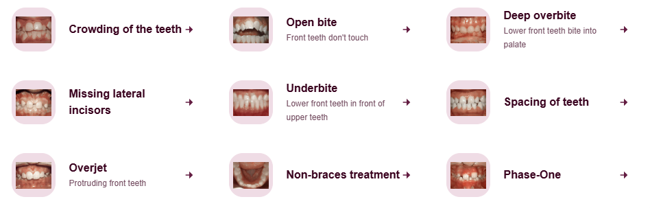 Orthodontic Treatment — Caldwell, ID — Webster Orthodontics