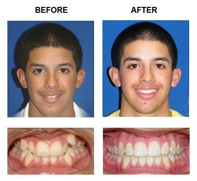 Patient Two Before and After — Caldwell, ID — Webster Orthodontics