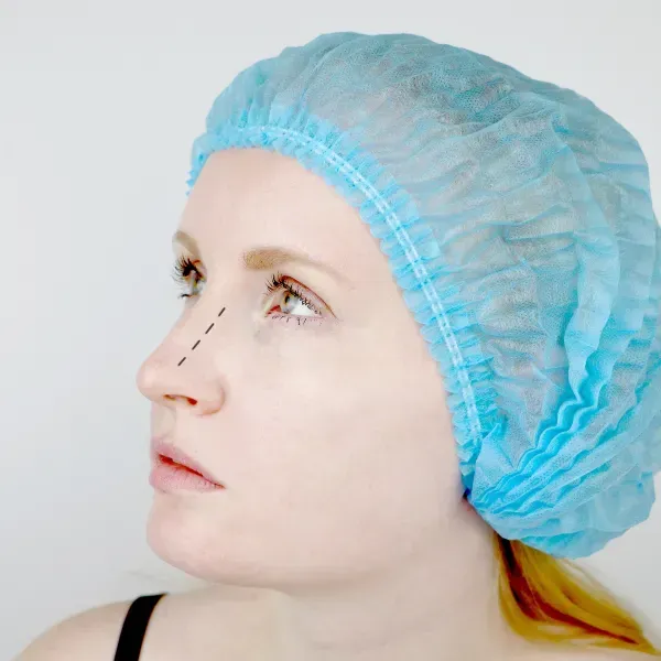 A woman wearing a blue surgical cap getting ready for septoplasty