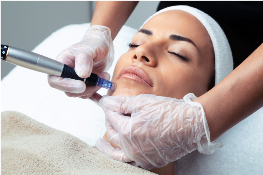 Cosmetic facial, micro, needling image.