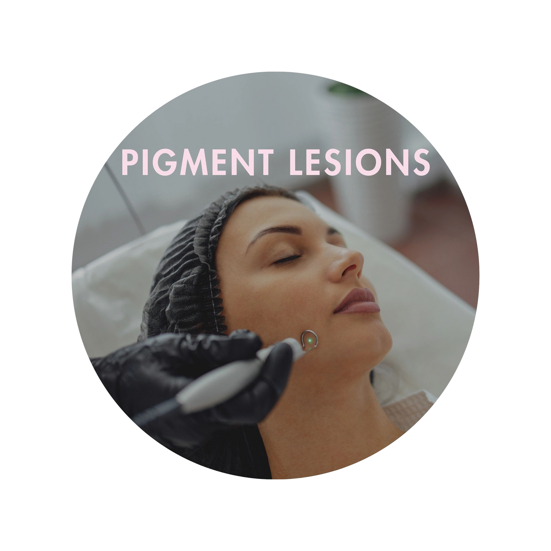 A woman is getting a treatment for pigment lesions on her face