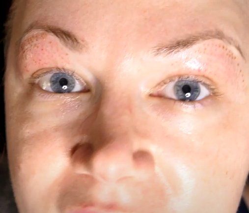 Fibroblasting